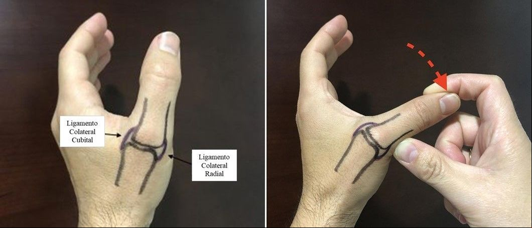 Lesión del pulgar del esquiador